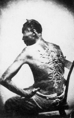 Scarred back of man who has been severely whipped.